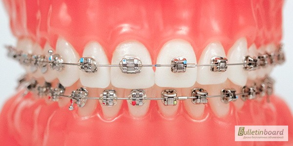 Фото 4. Стоматолог - Ортодонт. Все виды брекетов. Выравнивание зубов